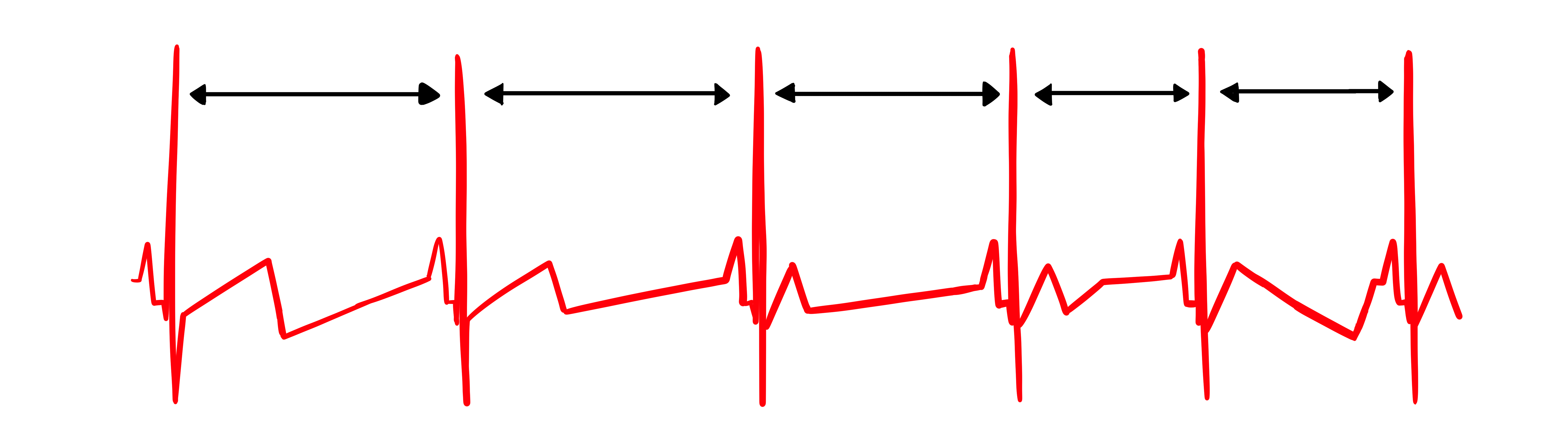 Record showing healthy heart rate variability with differing interbeat intervals